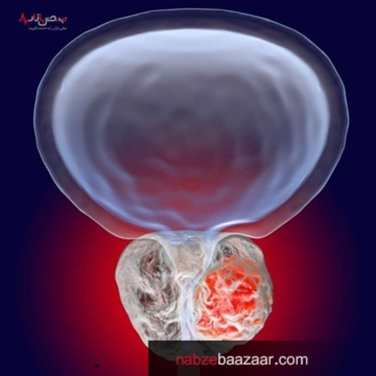 روش های تشخیص نوع سرطان پروستات