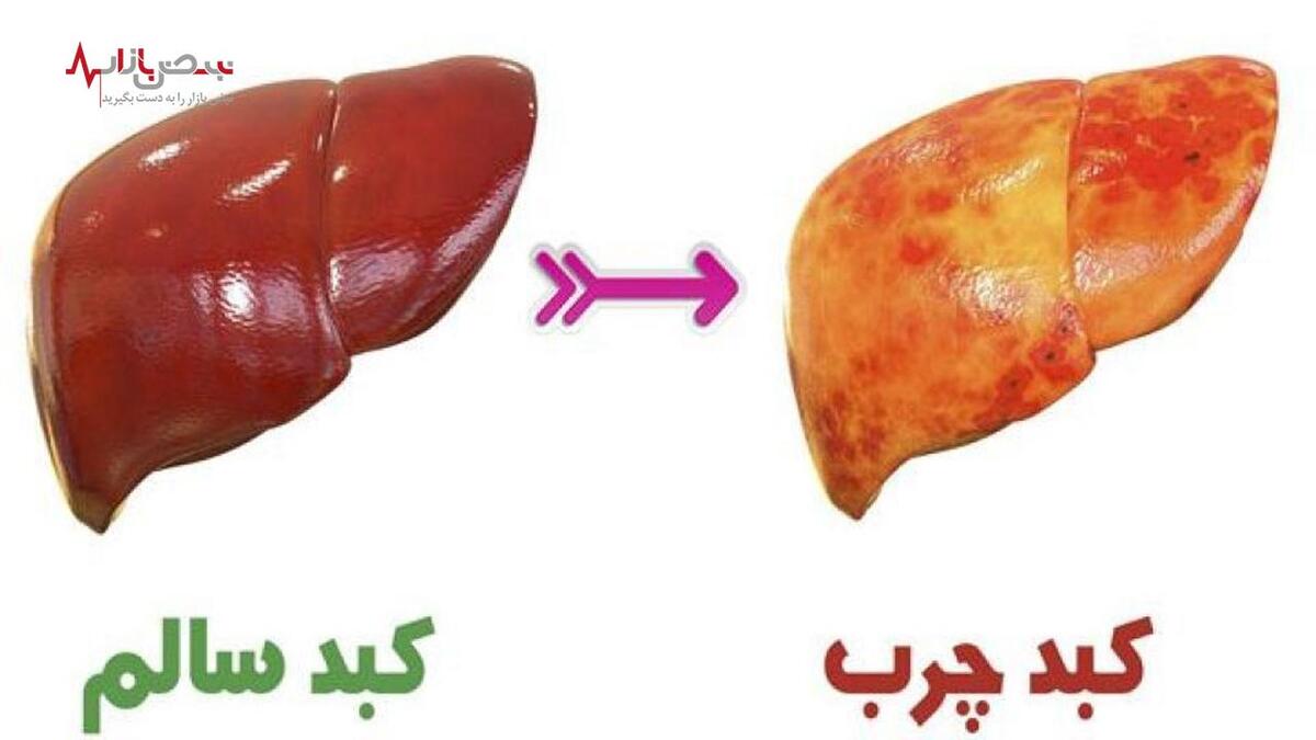 راه‌های پیشگیری و درمان قطعی کبد چرب